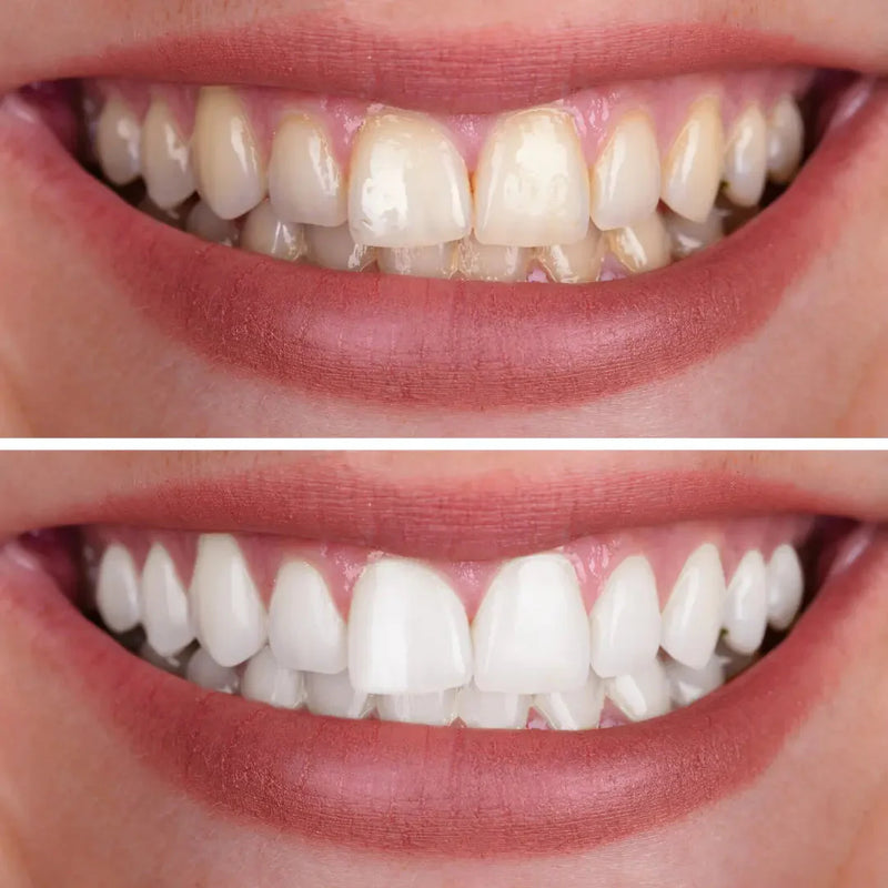 Clareador Dental Fórmula Inovadora V2.0 | Dentes Mais Brancos Sem Sair de Casa Ja Inovei